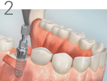 Einbringung Zahnimplantat