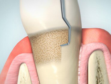 Geschlossene Paradontitistherapie